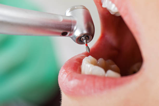 Best Emergency Tooth Extraction in Buchanan, MI